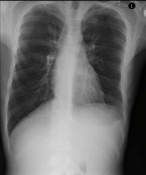 Case 1 20 years old No prior medical history Fever few days up to 39 C Dry cough Household