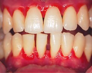 Interleukin-12 and