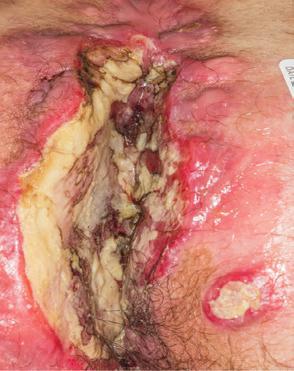 Leukocyte Adhesion Deficiency
