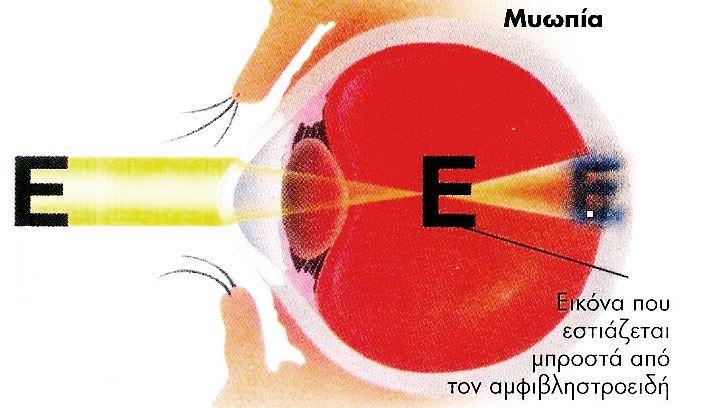 2. ΔΙΑΘΛΑΣΤΙΚΑ ΣΦΑΛΜΑΤΑ κάποιο σημείο που ταυτίζεται με το άπω σημείο του μυωπικού οφθαλμού. Σχήμα 2. 4 Μυωπία, η κύρια εστία εντοπίζεται μπροστά από τον αμφιβληστροειδή.