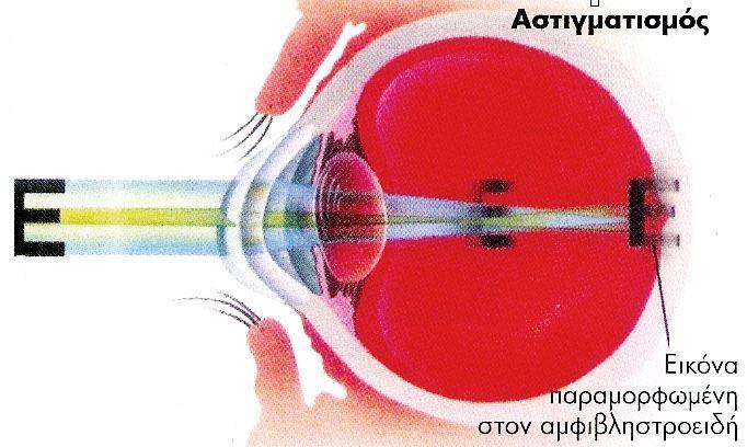 διοπτρικού συστήματος αυτού, δεν είναι ίδια σε όλους τους μεσημβρινούς, με αποτέλεσμα να μην είναι δυνατή η εστίαση όλων των ακτινών σε ένα σημείο.