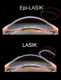 2.4 ΔΙΑΘΛΑΣΤΙΚΗ ΧΕΙΡΟΥΡΓΙΚΗ Σχήμα 2. 13 Σύγκριση μεθόδων EPI-LASIK και LASIK. Στην πρώτη περίπτωση αφαιρείτε το επιθήλιο ενώ στη δεύτερη δημιουργείτε flap πριν την εφαρμογή ακτινοβολίας laser.