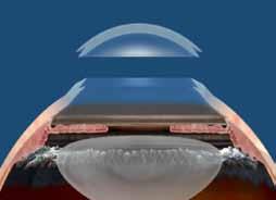 Stem Cell Tx, AK, CCI, Flap, ICR, LKP, PKP, Pocket. Soon FLEx, AK, Cataract Flap, PKP, LKP, FLEK, ICRS, AK Flap, DALK LKP PKP ICRS DSEK Flocket Flap, Limited PKP LKP.