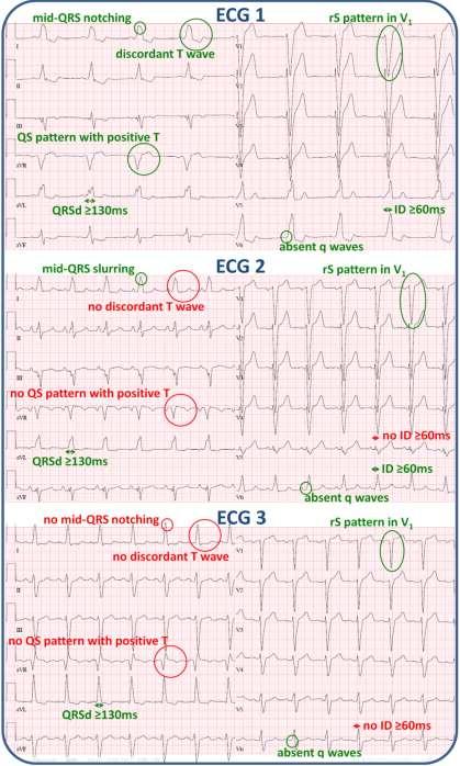 Identification of the strict LBBB QRS duration of 120 ms, QS or rs pattern in V1, intrinsicoid deflection (ID) time defined as time from start QRS to R peak of 60