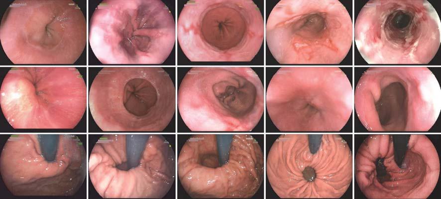 40 2018 1 1 43 1 1 2 3 4 5 A B C 1 HH Fig. 1 The manifestations of esophagitis and hiatus hernia under general gastroscope A1. Normal esophageal mucosa; A2-A5. Esophagitis LA-A - LA-D; B1, C1.
