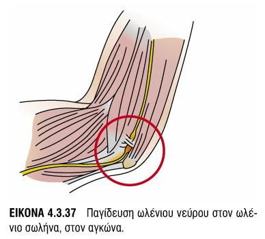 επικονδυλίτιδααγκώνα Αγκώνας Ωλένια νευρίτιδα 1η -3η/4η Συνεδρία=17B1, 17Β5,