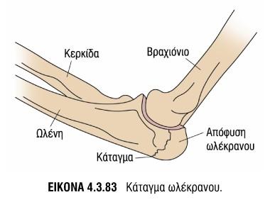 Συνεδρία=16Α5,17Α6 Αγκώνας Εξάρθρημα αγκώνα Έμφαση στην οπίσθια πλευρά του