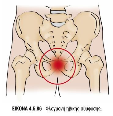 6Α4,10Α1-10Α5,13Β2,13Β5 Τενοντοπάθεια Προσαγωγών Ισχίου 1η -3η/4η