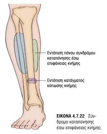έσω πλάγιο],3α3,3α4,3α5 (με εφαρμογή πανω στον έσω πλάγιο σύνδεσμο).