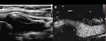 Πηγή: Staub D et al. Correlation of carotid artery atherosclerotic lesion echogenicity and severity at standard US with intraplaque neovascularization detected at contrast enhanced US. Radiology.