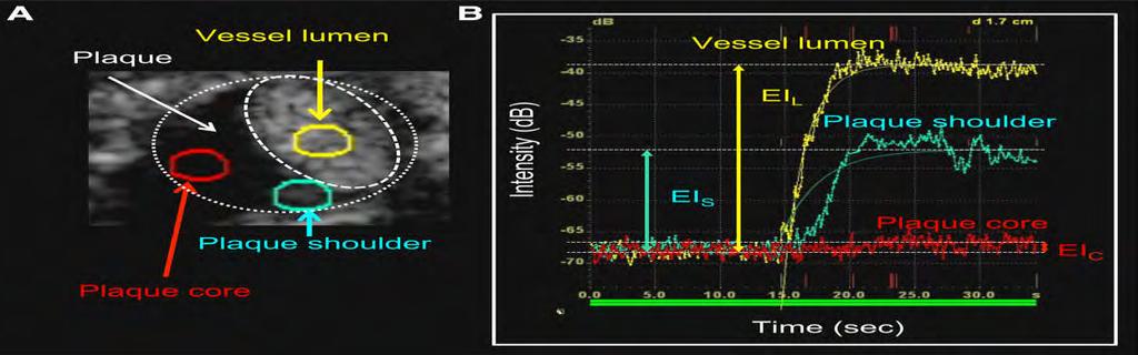 Πηγή: Saito K. et al., Contrast-Enhanced ultrasound for the evaluation of neovascularization in atherosclerotic carotid artery plaques Stroke. 2014;45:3073-3075. 1.