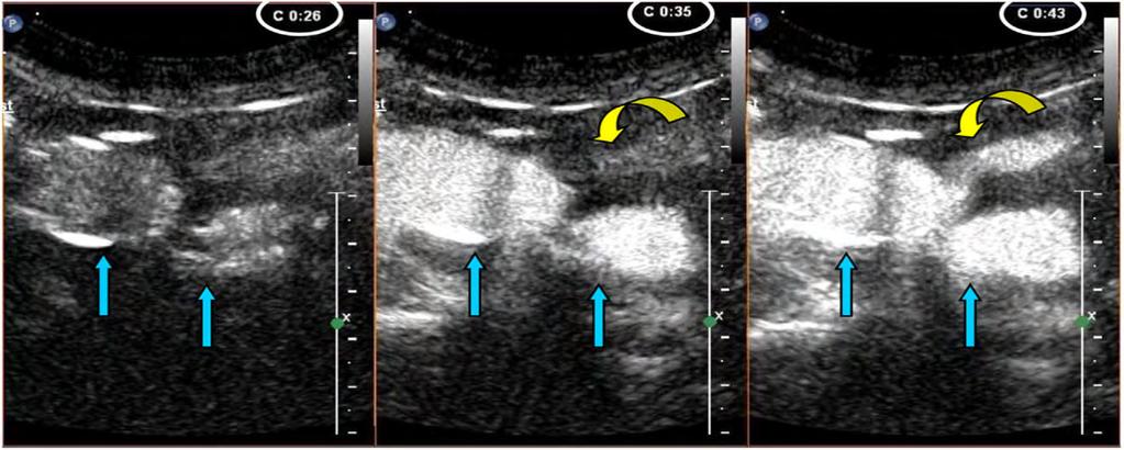 Πηγή:Millen et al. Defining a role for contrast-enhanced ultrasound in endovascular aneurysm repair surveillance.