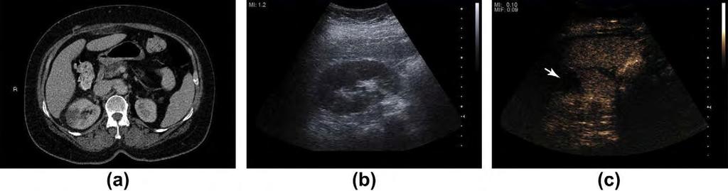 Πηγή : Current and potential renal applications of contrast-enhanced ultrasound Mc