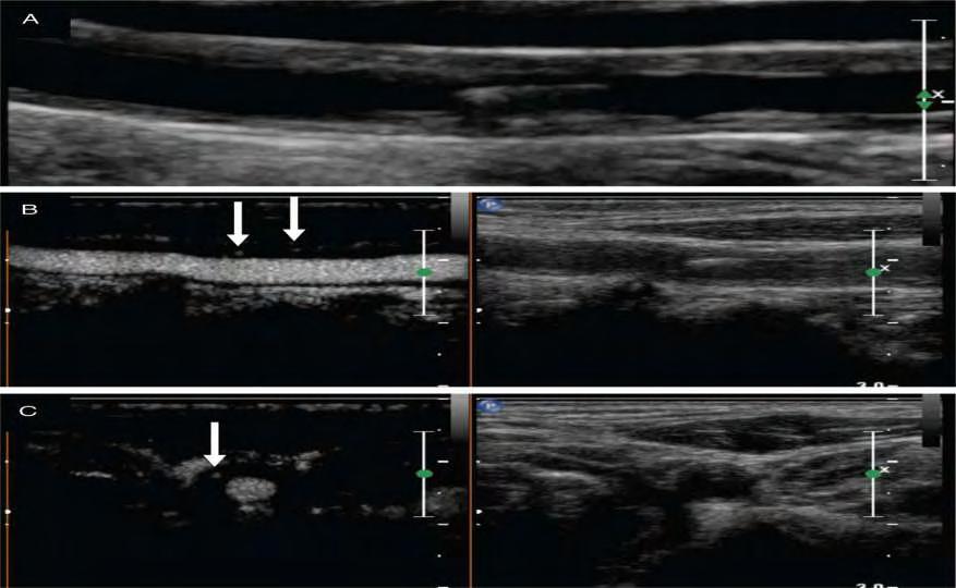 Πηγή : Schinkel A.F.L. et al. Utility of contrast-enhanced ultrasound for the assessment of the carotid artery wall in patients with Takayasu or giant cell arteritis.