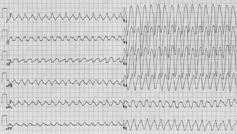 Atrial flutter with 1:1