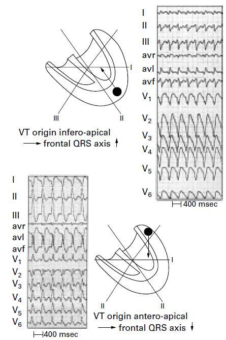 Influence of site of origin of VT on QRS axis right superior-axis VTs arise from apical septal or apical lateral regions, often demonstrating QS complexes in leads I, II, and III