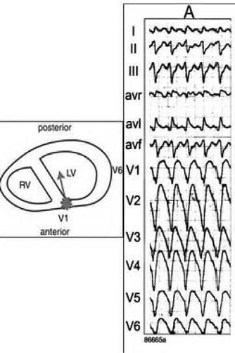 Precordial concordance during ventricular tachycardia negative