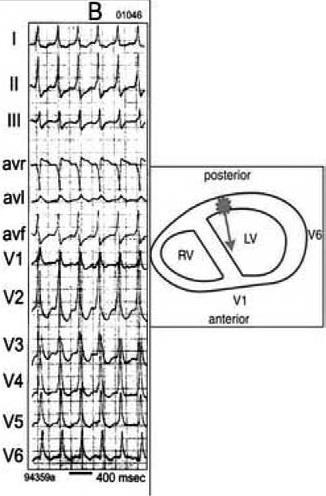 of the ventricle, typically in anterior apical positive concordance is