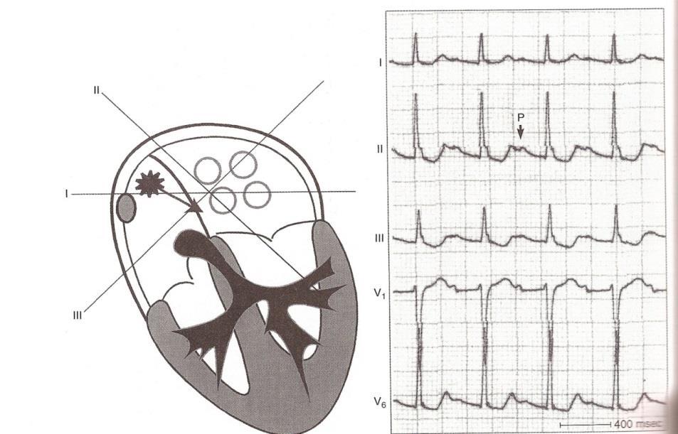 Focal Atrial Tachycardia P-wave rate of >250/min