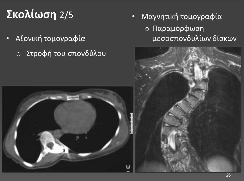 Εικόνα 1.8. Αξονική τομογραφία για διάγνωση σκολίωσης πηγή: slideplayer.
