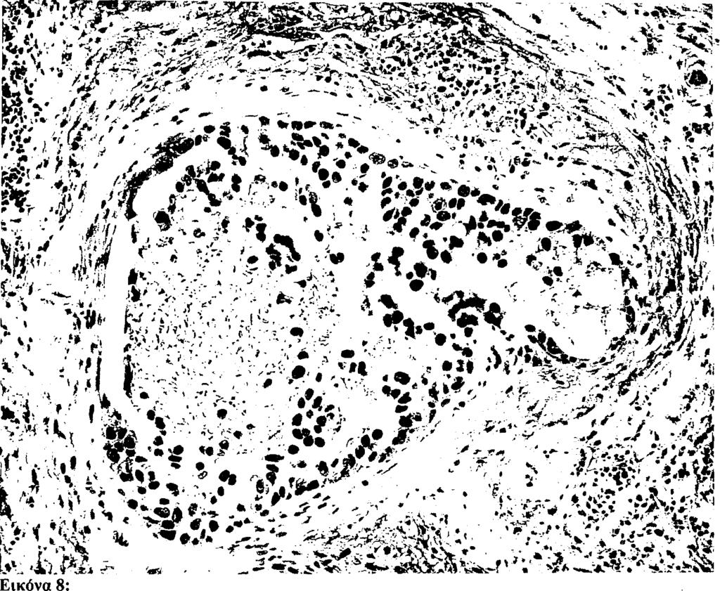 62 Πορογενές μη διηθητικό (in situ) αδενοκαρκίνωμα του μαστού, με κεντρική νέκρωση και κυτταρική ατυπία (comedo-grade III).