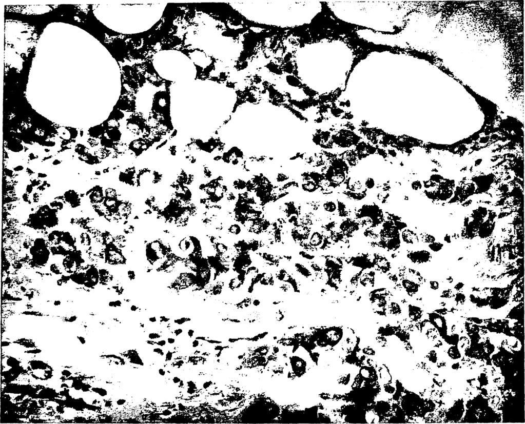 Ψ 63 Εικόνα 9: Πορογενές διηθητικό αδενοκαρκίνωμα του μαστού μη ειδικού τύπου grade II.