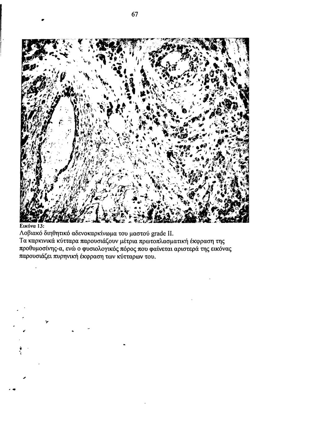 9 67 Εικόνα 13: Λοβιακό διηθητικό αδενοκαρκίνωμα του μαστού grade