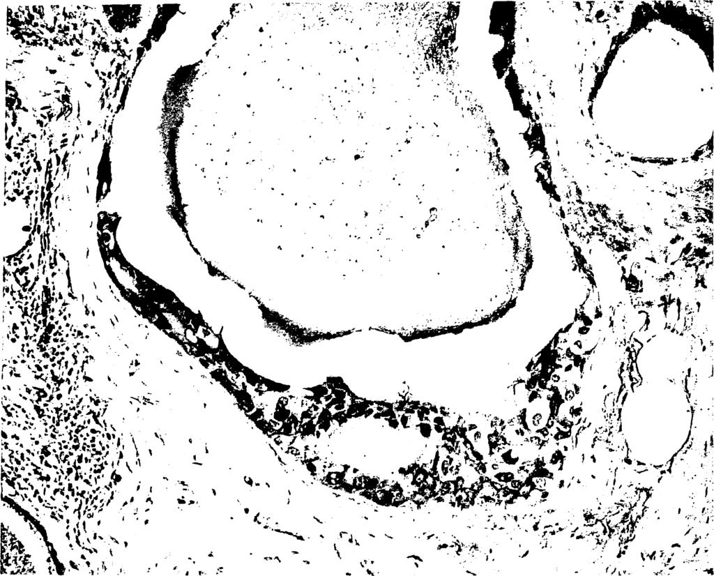 69 Εικόνα 15: Πορογενές μη διηθητικό (in situ) αδενοκαρκίνωμα του μαστού τύπου comedo (grade III).