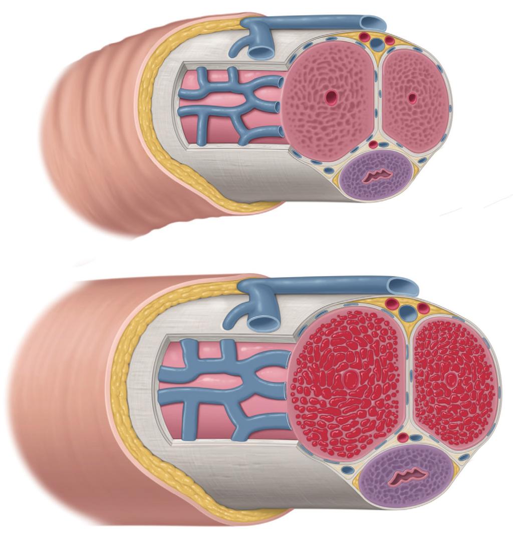 Διάγνωση του πριαπισμού Το πέος αποτελείται από δύο κοίλα όργανα (σηραγγώδη σώματα) και μία μάζα από σπογγώδη ιστό (σπογγώδες σώμα).