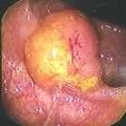 Adenoma