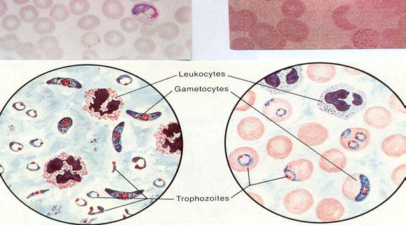 Α Β Γ Δ Ε λευκοκύτταρα γαμετοκύτταρα τροφοζωίδια Εικόνα-56: Ενδοερυθροκυτταρικά πλασμώδια της ελονοσίας.