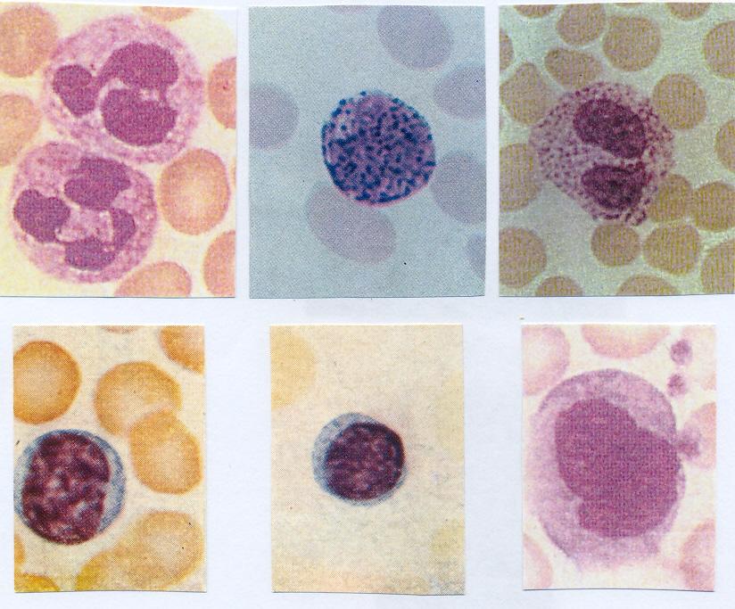 ΔΙΑΓΝΩΣΤΙΚΗ ΠΡΟΣΕΓΓΙΣΗ 267 Μορφολογική εικόνα των λευκοκυττάρων (εικόνες-62, 63) Από το ίδιο επίχρισμα του περιφερικού αίματος, εκτός από τον συνολικό αριθμό, συλλέγονται πληροφορίες που αφορούν την