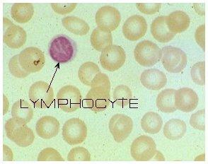 Λευκοκυτταρικός τύπος Λεμφοκύτταρα Αιτίες λεμφοκυττάρωσης Αιτίες λεμφοπενίας Ιογενείς λοιμώξεις Φλεγμονώδη νοσήματα εντέρου Χρόνια