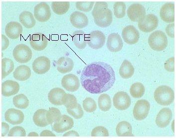 Λευκοκυτταρικός τύπος Μονοκύτταρα Αιτίες μονοκυττάρωσης Λοιμώξεις (συχνά δε φάση ανάρρωσης), φλεγμονώδη νοσήματα (σαρκοείδωση), νεοπλάσματα Οξεία μονοκυτταρική
