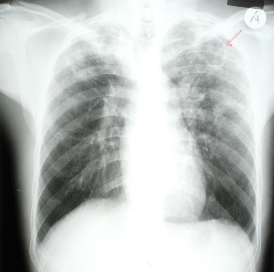 Ασθενής άνδρας 28 ετών με εκτεταμένη, αμφοτερόπλευρη, σπηλαιώδη (Α), ενεργό πνευμονική φυματίωση αρχίζει αντιφυματική θεραπεία με