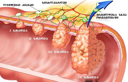 სკრინინგი ითვალისწინებს : ganavlis tests farul sisxldenaze; ganavlis testis dadebiti pasuxis SemTxvevaSi kolonoskopias.