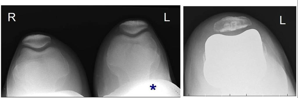 Κατ εφαπτομένη προβολή επιγονατίδας Skyline προβολή The radiograph on the left demonstrates bilateral patellae.
