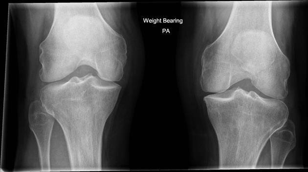 Ο-Π προβολή γόνατος σε όρθια κάμψη The Rosenberg view of the knees is a specialised series often used to detect early signs of osteoarthritis.
