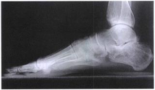 Distal fibula should be seen superimposed over posterior half of the tibia, and
