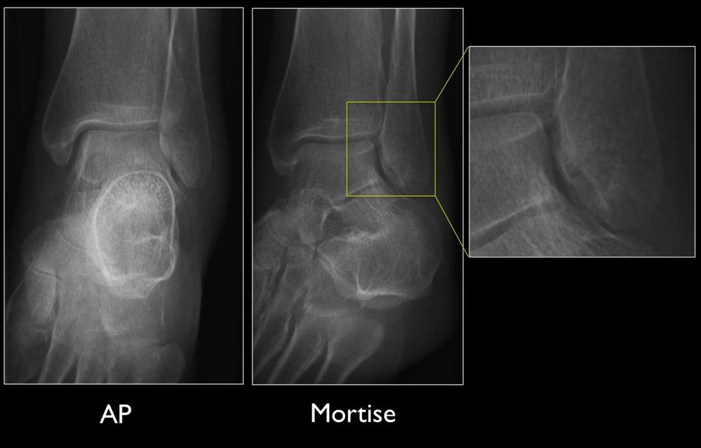 Ποδοκνημική άρθρωση : 45 έσω λοξή AP and Mortise view of the left ankle in case
