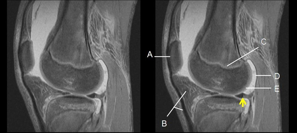 Ανατομία άρθρωσης γόνατος επιγονατίδα (A), σύνδεσμος επιγονατίδας υποεπιγονατιδικό στρώμα λίπους