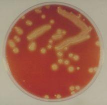 Οξεία αιματογενής οστεομυελίτιδα Υπεύθυνοι μικροοργανισμοί Νεογνά S.Aureus Group B Strept.