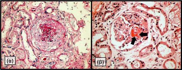 Οξεία Νεφρική Βλάβη Εκόνα 1: α) Κυτταρικός μηνοειδής σχηματισμός που περιβάλλει ολόκληρο το σπείραμα. β) Τμηματική ινιδοειδής νέκρωση (βέλη). (Ευγενική παραχώρηση από την καθηγήτρια Λ.