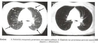 Πνευµονικές µεταστάσεις Ο πνεύµονας αποτελεί το 2 ο σε συχνότητα όργανο εµφάνισης µεταστάσεων µετά το ήπαρ