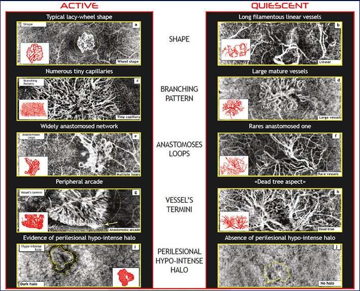 Εκφυλίσεις ΗΕΩ- υγρή μορφή Coscas et al, Retina, 2015 Ποιοτικά χαρακτηριστικά ενεργού έναντι