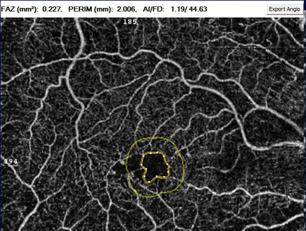 Kitagawa et al, Retina, 2017 13 οφθαλμοί πριν και μετά PPV Ήπια διεύρυνση AΖ ΜΤΧ όμως σημαντικά μικρότερη σε σχέση με