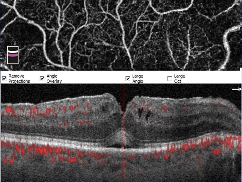 του επιπολής τριχοειδικού δικτύου ΜΤΧ Kim et al, Br J Ophthalmol, 2018 43 οφθαλμοί πριν και μετά PPV Μειωμένη ΑΖ και