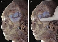 ; et all Plastic and Reconstructive Surgery. 136 (5S): 204S-218S, November 2015. Figure 5. The suggested area for safe filler injection.