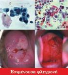 Cervical human papillomavirus prevalence in 5 continents; meta-analysis of 1 million women with normal cytological findings J Infect Dis. 2010; 202(12): 1789-99.