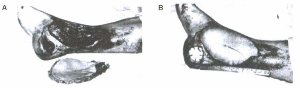 Εικόνα 17: Ο πρώτος επιτυχής ελεύθερος κρημνός από τους Taylor και Daniel Από εκείνη την εποχή, δεκάδες μικροαγγειακές μεταφορές (δέρματος, μυών, οστών, νεύρων, τενόντων και διαφόρων άλλων